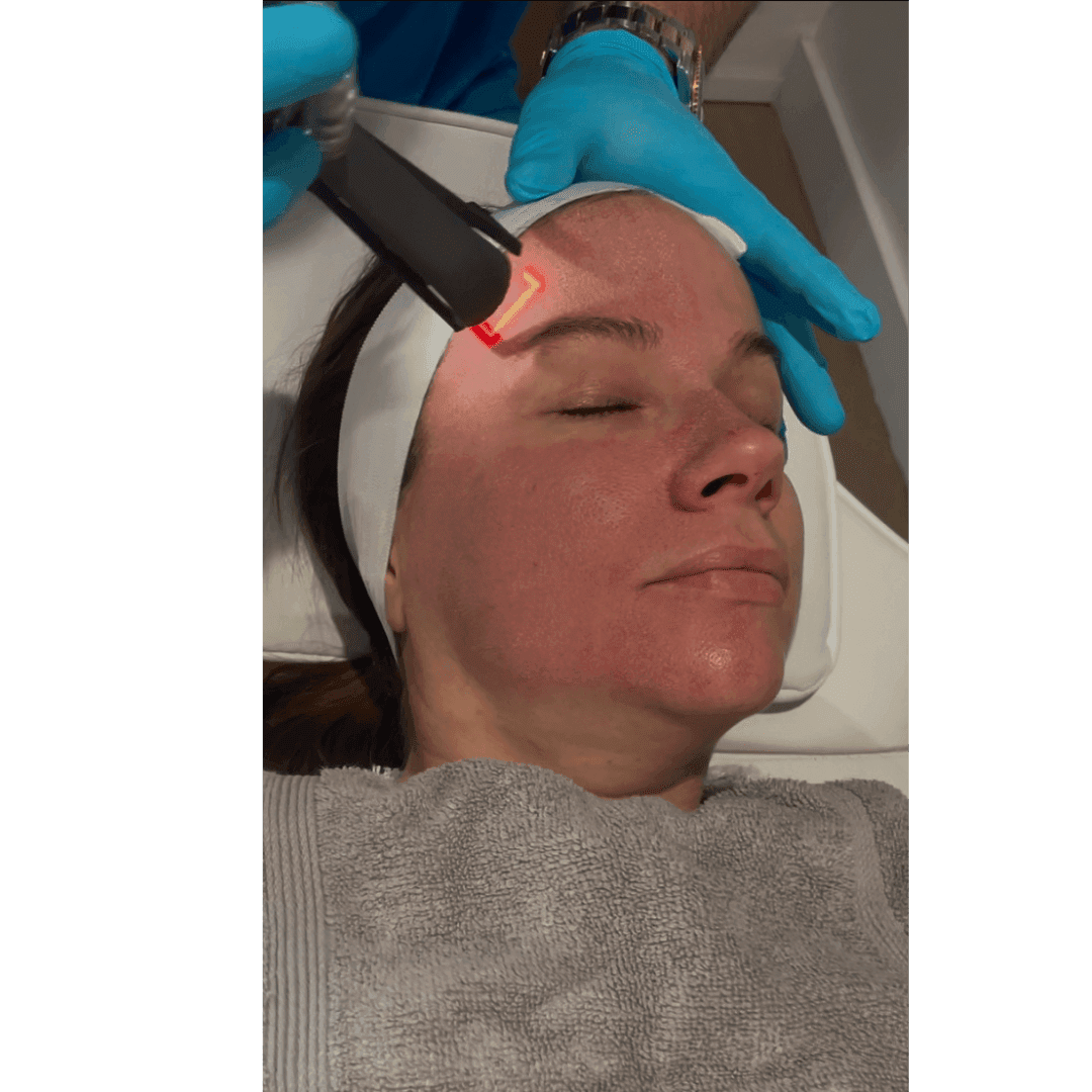 Cool Peel CO2 laser to help skin texture, anti-aging, build collagen, reduce lines